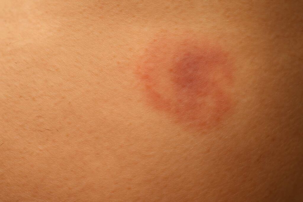 early skin changes on high risk areas that families may notice