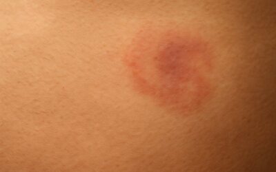 Early Skin Changes Families Can Look For